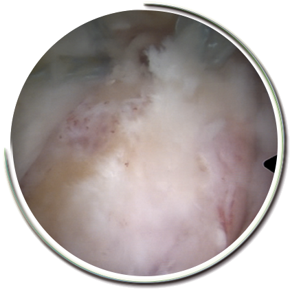 Rotator Cuff rupture